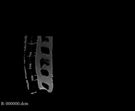 MRI slice after window-leveling to reduce gray noise